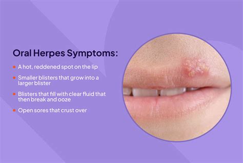 things that are similar to herpes